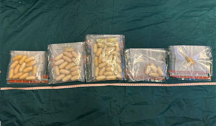 海關(guān)機場偵破旅客體內(nèi)藏毒案件 檢獲市值120萬懷疑可卡因