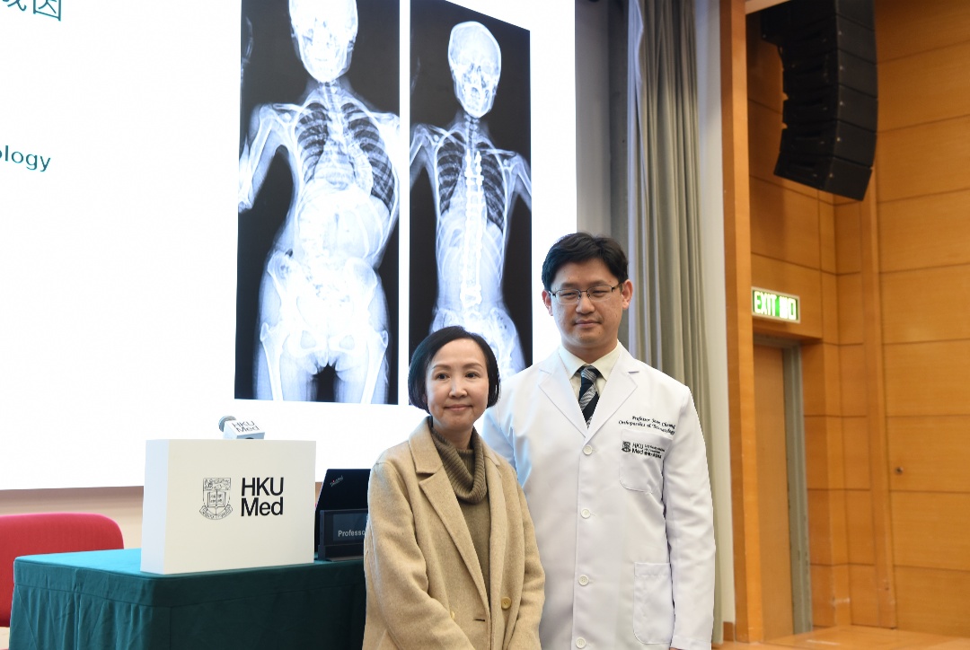 港大就原發(fā)性脊柱側(cè)彎取得全球突破  主因為SLC6A9基因變異