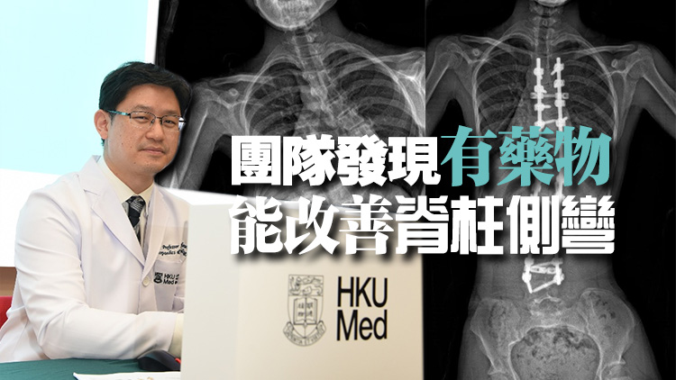 港大就原發(fā)性脊柱側(cè)彎取得全球突破  主因?yàn)镾LC6A9基因變異