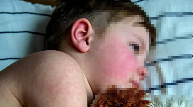 又現(xiàn)死亡病例！美國一兒童因感染麻疹死亡